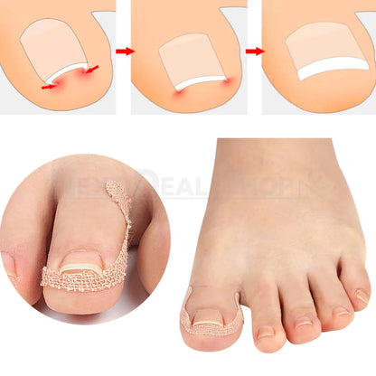 20 Pcs - Ingrown Nail Correction Bandage-Next Deal Shop-Next Deal Shop