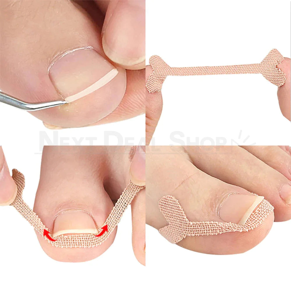 20 Pcs - Ingrown Nail Correction Bandage-Next Deal Shop-Next Deal Shop