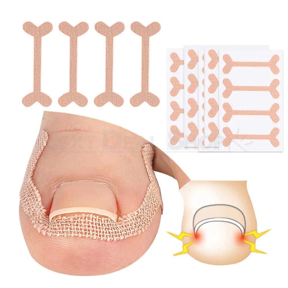 20 Pcs - Ingrown Nail Correction Bandage-Next Deal Shop-Next Deal Shop